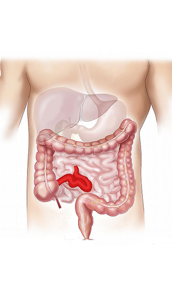 염증성 장질환 초음파